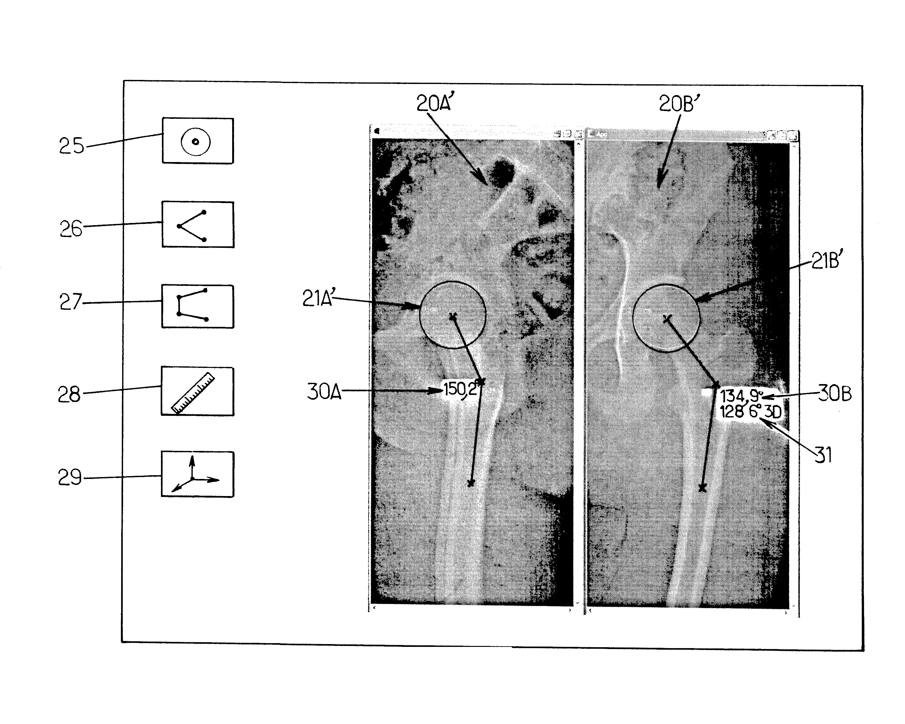 Mesure de grandeurs geometriques intrinseques a un systeme anatomique