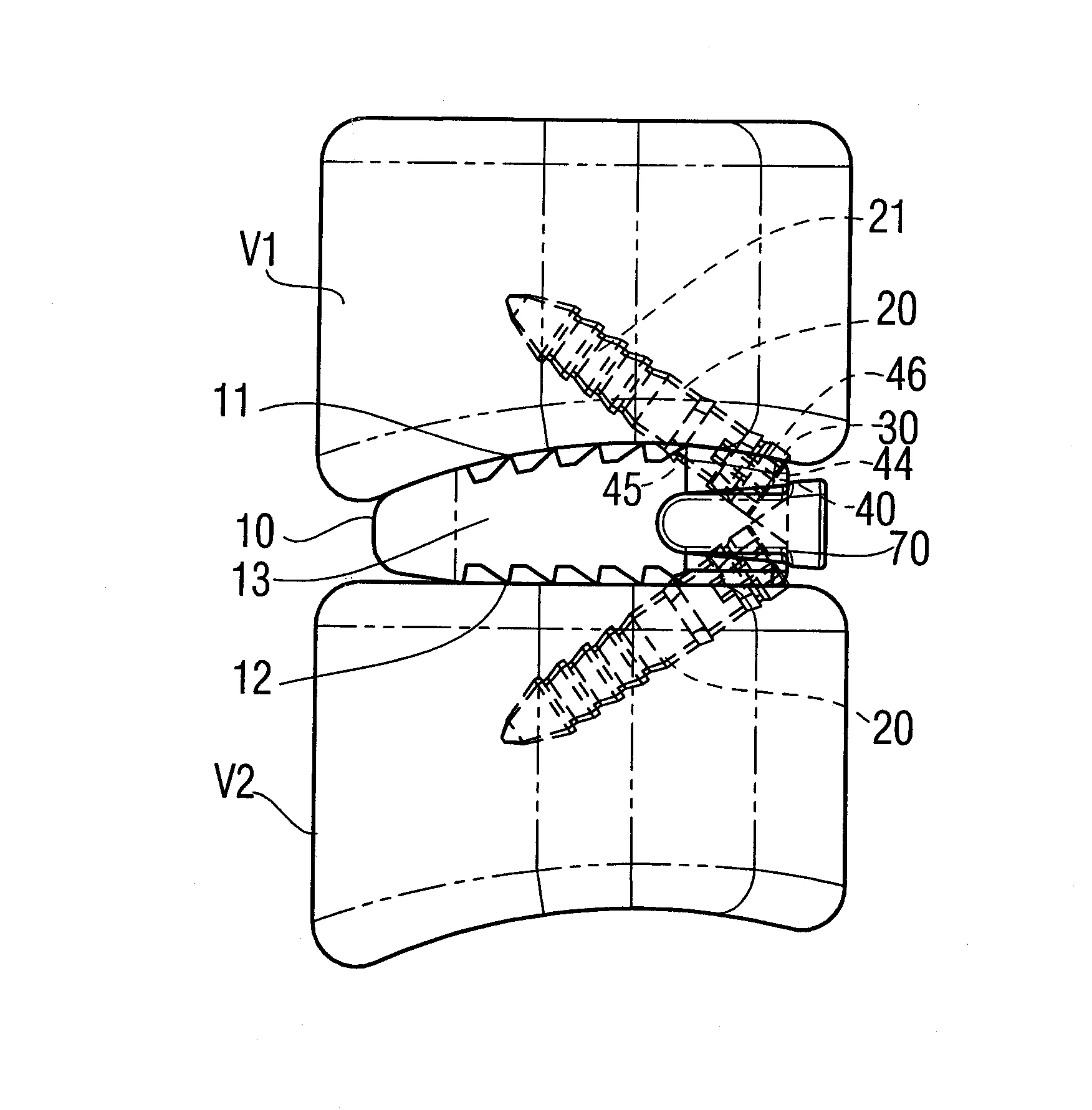 Systeme pour realiser une arthrodese entre deux vertebres