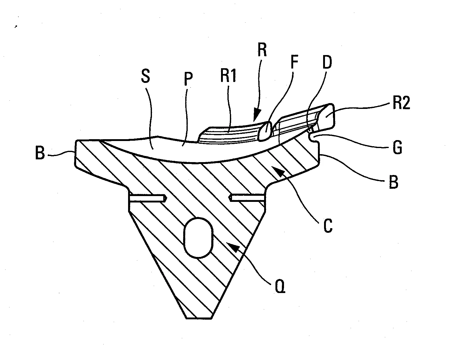 Implant glenoidien.