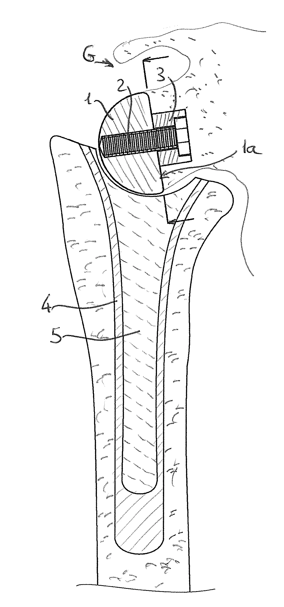 Prothese pour l'articulation de l'epaule