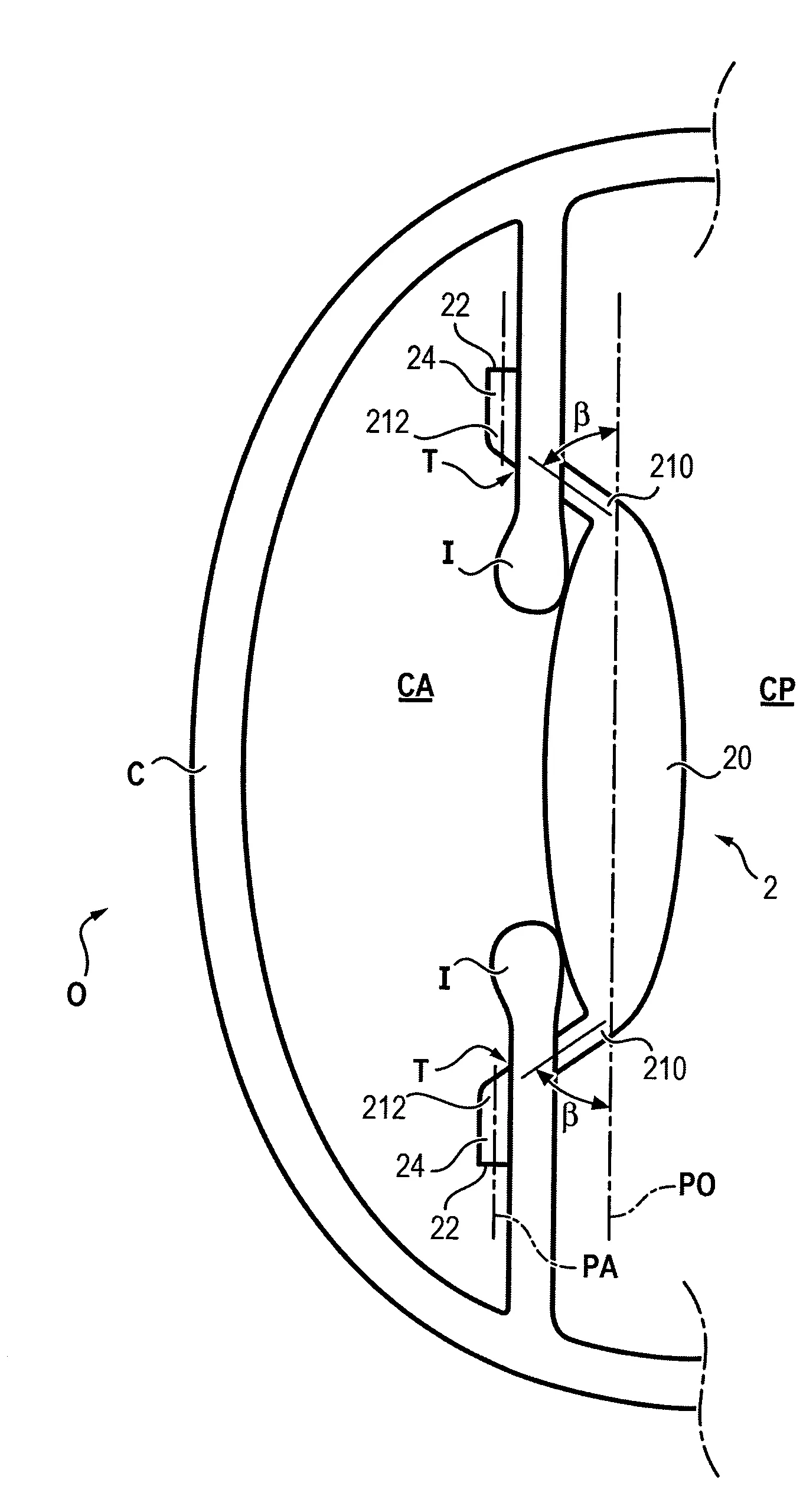 Implant intraoculaire trans-irien