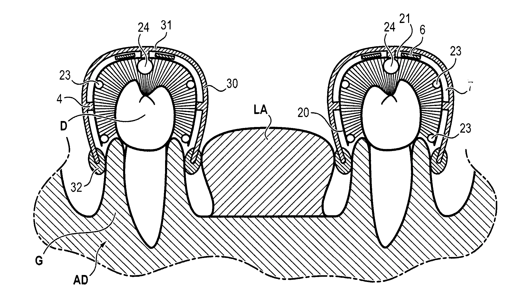 Dispositif de nettoyage et/ou de traitement d'une arcade dentaire.